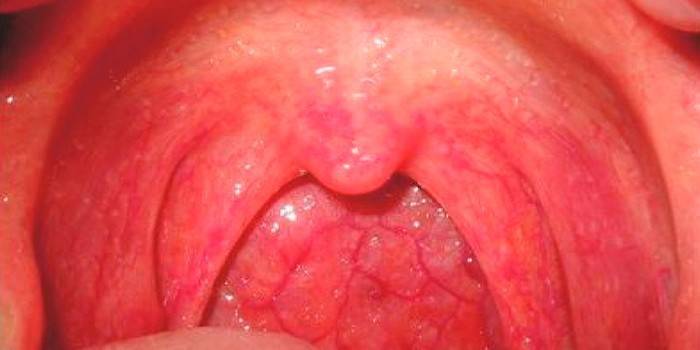 Scarlatine