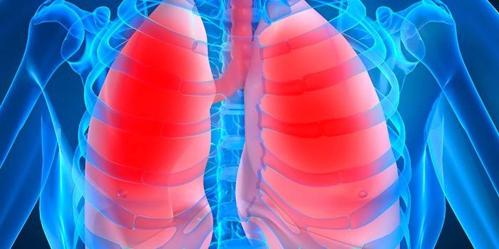 Pneumonie