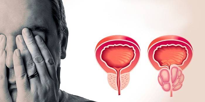 Modèle d'inflammation masculine et de la prostate