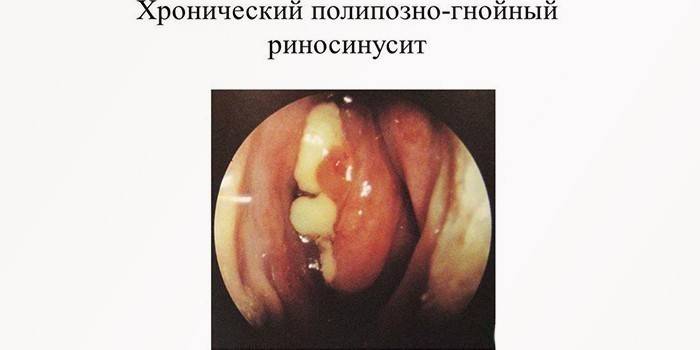 Rinosinusite polipo-purulenta cronica