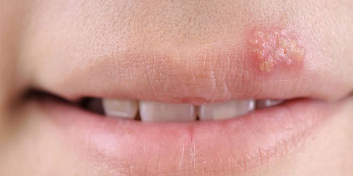 manifestazione del virus dell'herpes sul labbro superiore