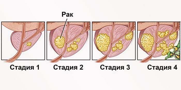 Prostatas vēža stadijas