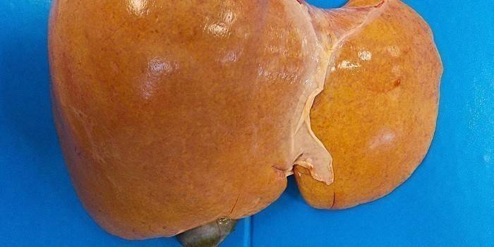 Fegato grasso affetto da epatosi