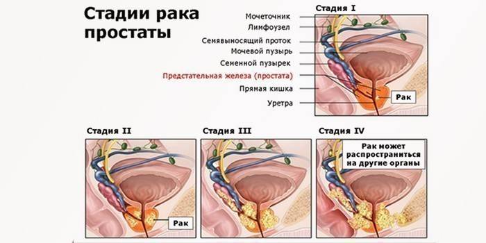 Etapas del cáncer de próstata