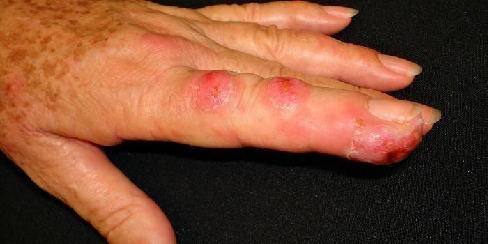 Sporotrichosis על אצבע של אישה