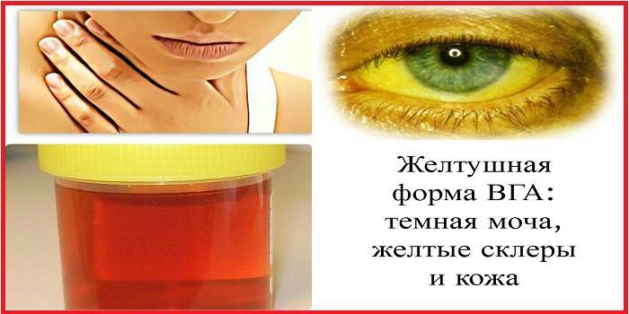 A hepatīta simptomi