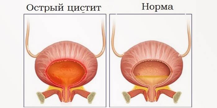 Forma acuta
