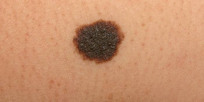 Naevus mélanocytaires dysplasiques sur la peau