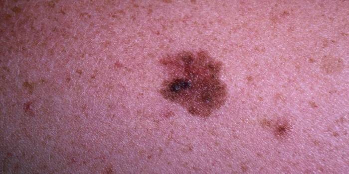 Naevus dysplasique sur la peau