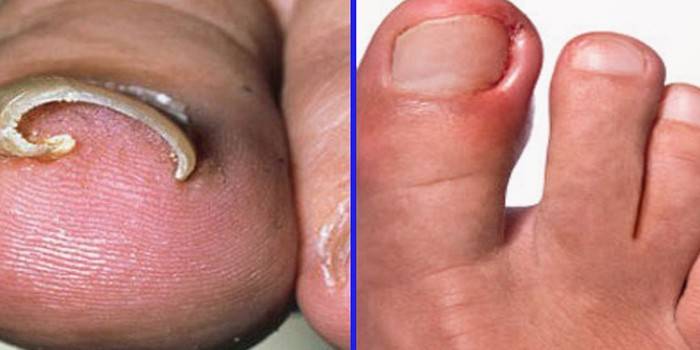 Ongles incarnés avant et après la procédure