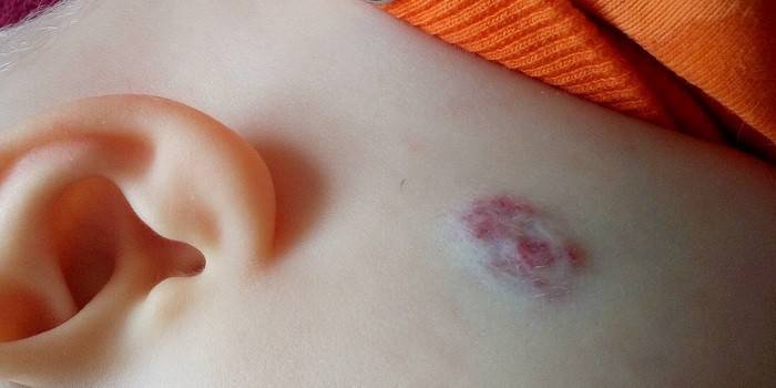 Naevus dysplasique sur la peau d'un enfant