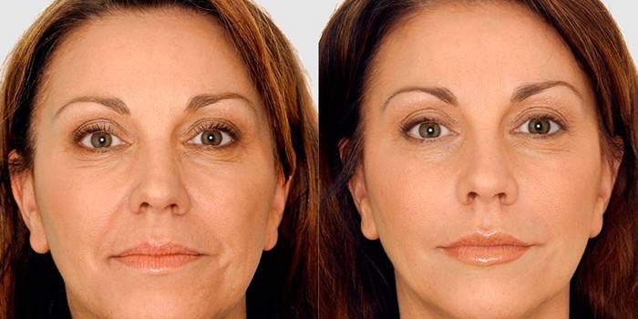 Faire face avant et après les procédures matérielles