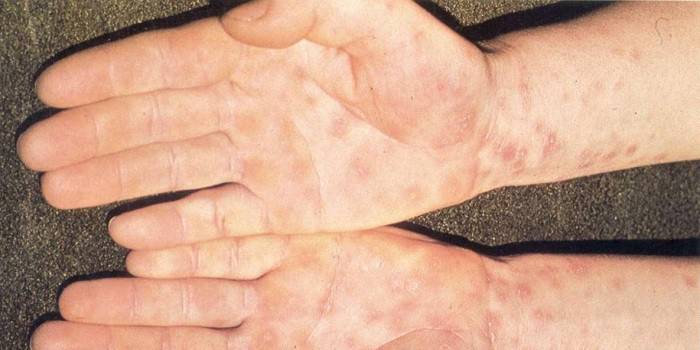 Eruzione cutanea della sifilide sulla pelle delle mani