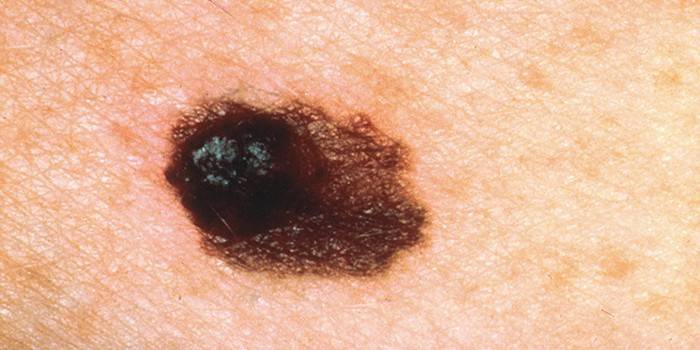 Carcinoma a cellule basali solide