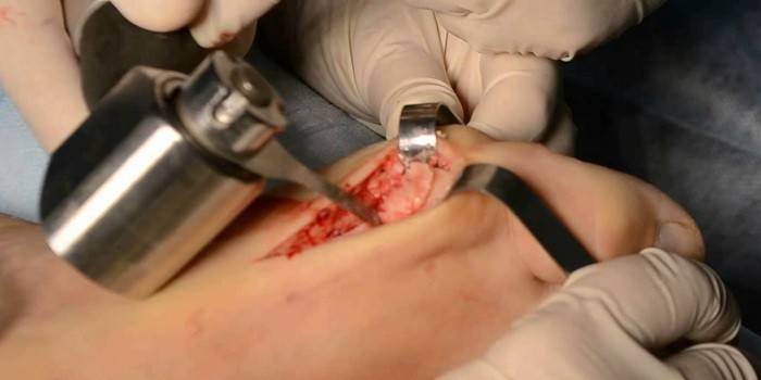 Chirurgie orthopédique du pied