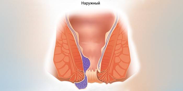 Esquema de hemorróidas externas