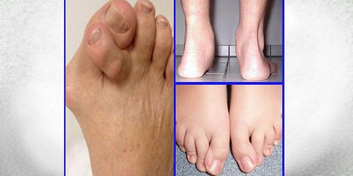 Types de déformation du pied