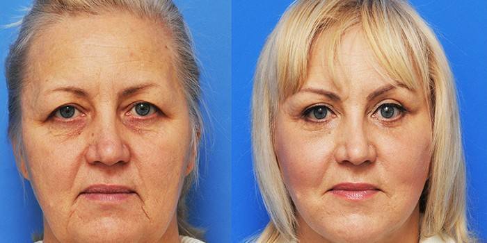 Métodos Carol Maggio - Fotos antes y después