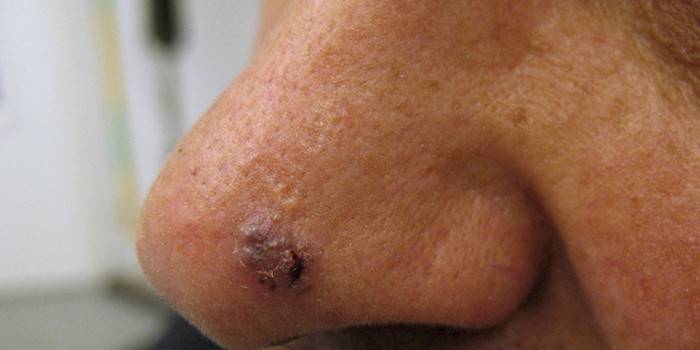 Cancro cellulare al naso