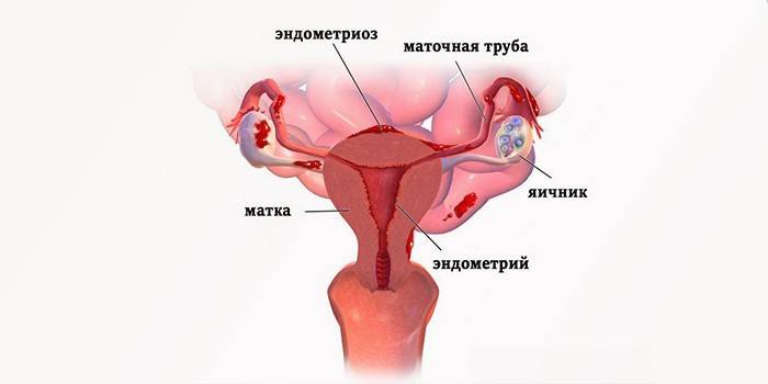 Endometriosis uterina