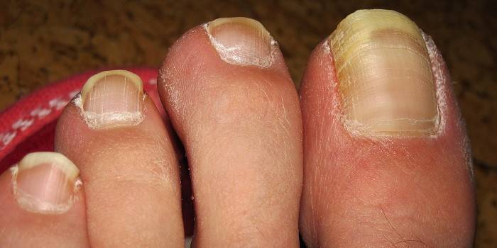 onychomycosis