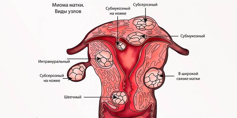 Τύποι ινομυωμάτων