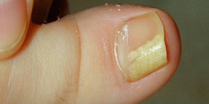 Infection fongique