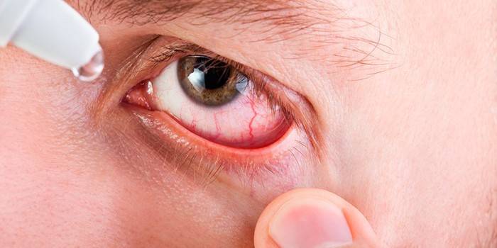 การปลูกฝังในถุง conjunctival ของตา