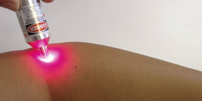 Rimozione della vongola laser