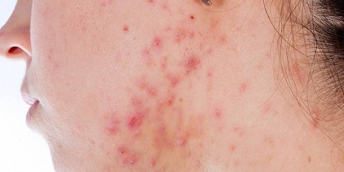 A candidiasis megnyilvánulása az arc bőrén