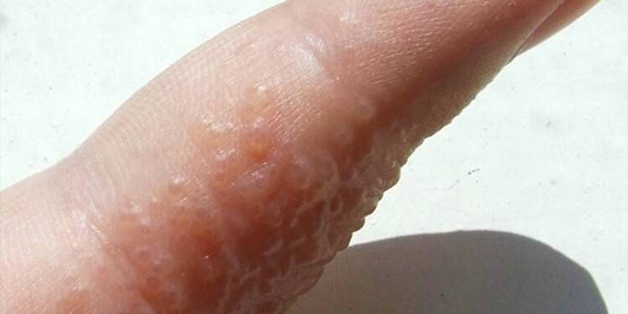 ภาพถ่ายของผื่น herpetic