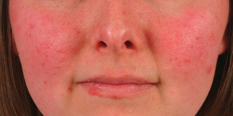 Lupus érythémateux systémique