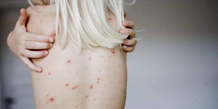 Eruzione cutanea sul retro di una ragazza