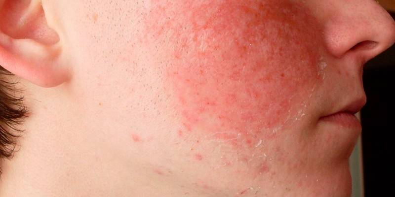 Allergie à la joue