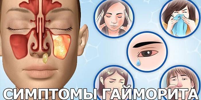 Segni di sinusite nell'uomo