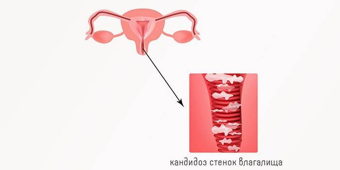 Vaginale Candidiasis