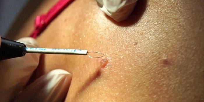 Enlèvement chirurgical des taupes
