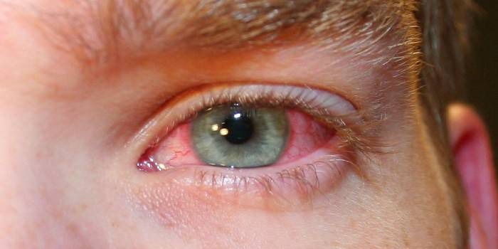 Der Mann hat ein rotes gereiztes Auge