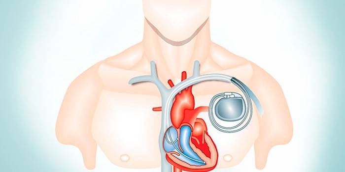 Pacemaker integrat