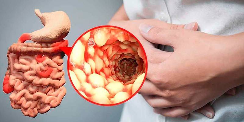 Triệu chứng của ULC ở người lớn