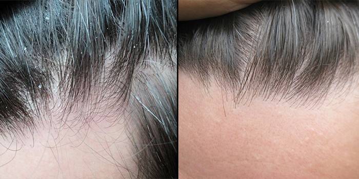 L'uso di shampoo Nizoral