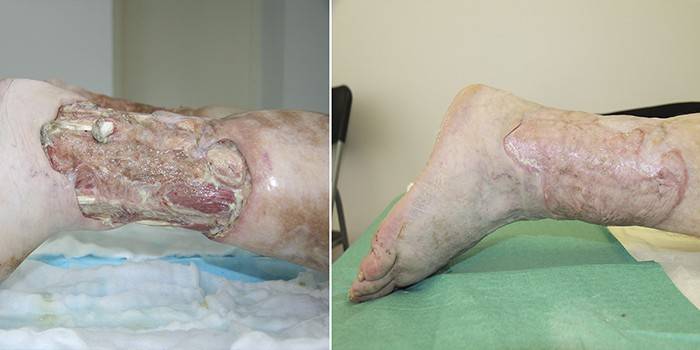 Úlceras venosas da perna.