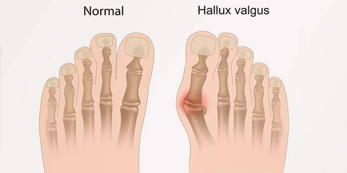 Position normale du pied et Hallux valgus