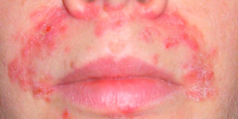 Infection fongique