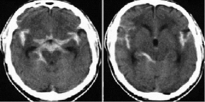 A subarachnoid vérzés diagnosztizálása
