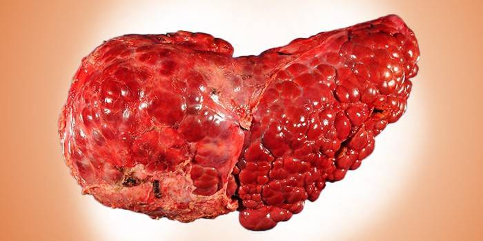 Cirrosi alcolica del fegato