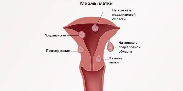 Tipos de fibromas uterinos