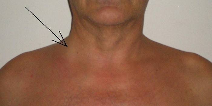 Trombose i jugularvenen
