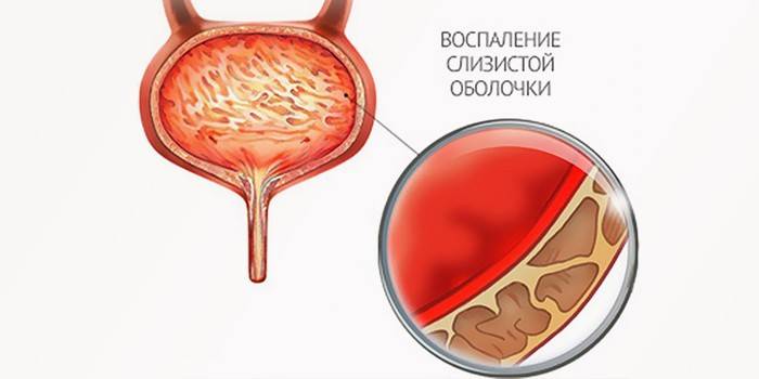 Inflamația vezicii urinare