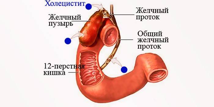 colecistite